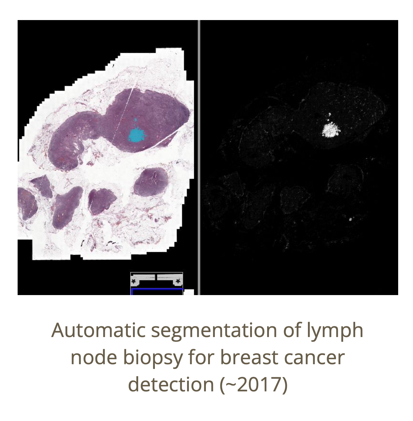 Camelyon Breast Cancer Segmentation Challenge